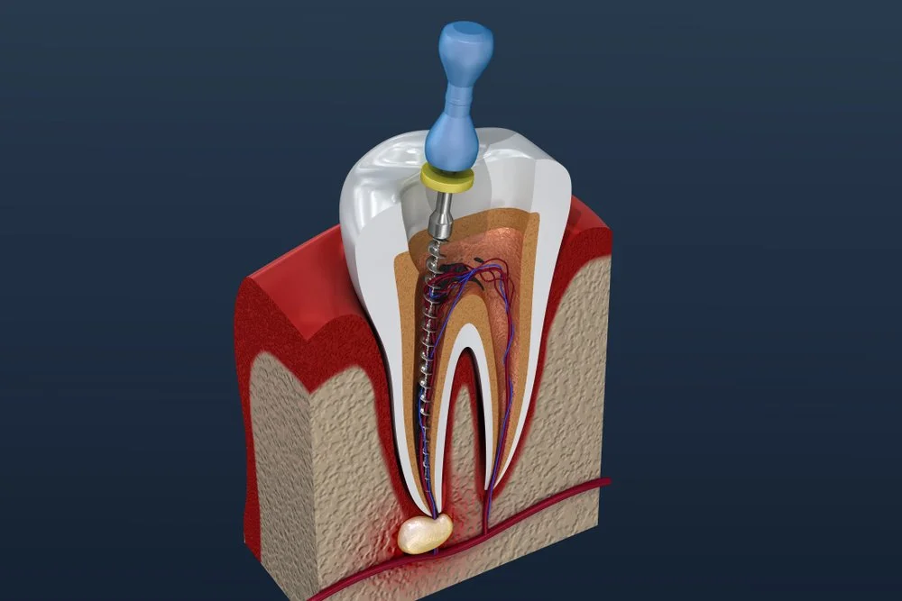 Why Do You Need a Root Canal?