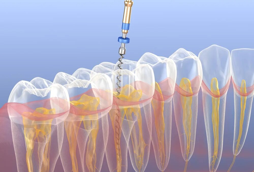 Debunking the Top 5 Myths about Root Canals