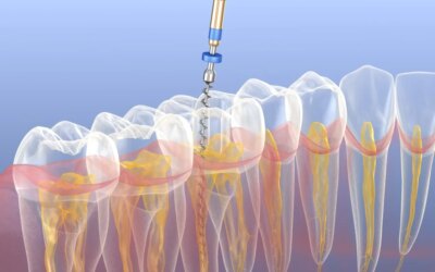 Debunking the Top 5 Myths about Root Canals