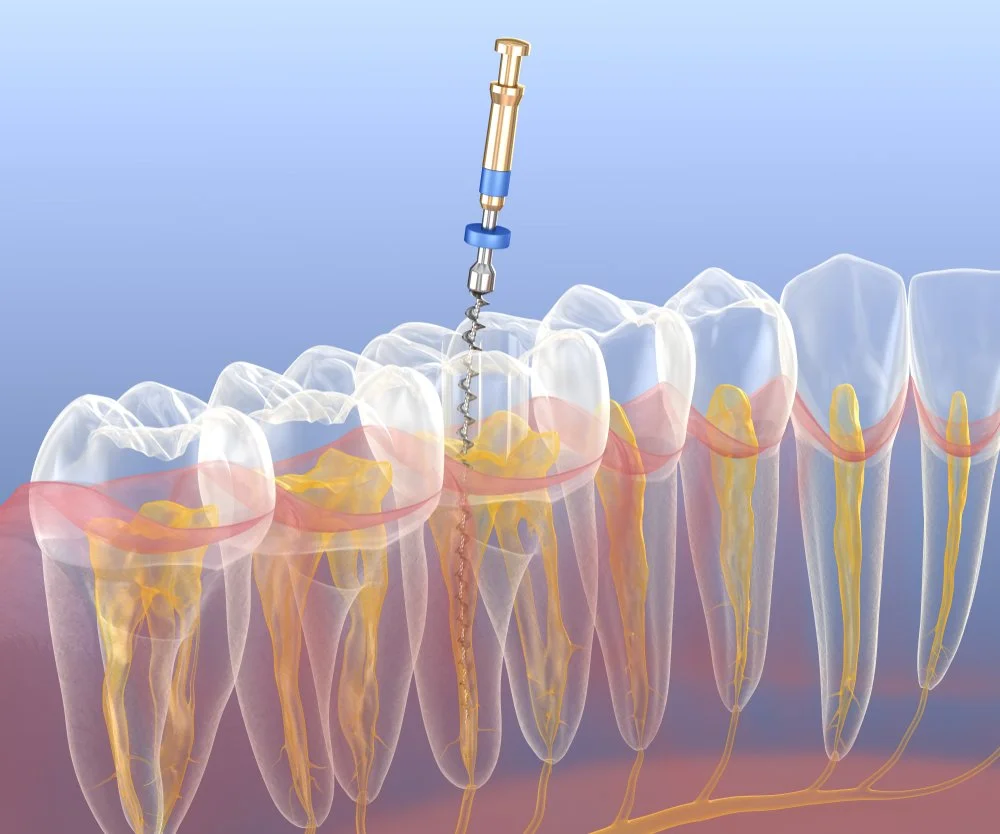Root canal treatment
