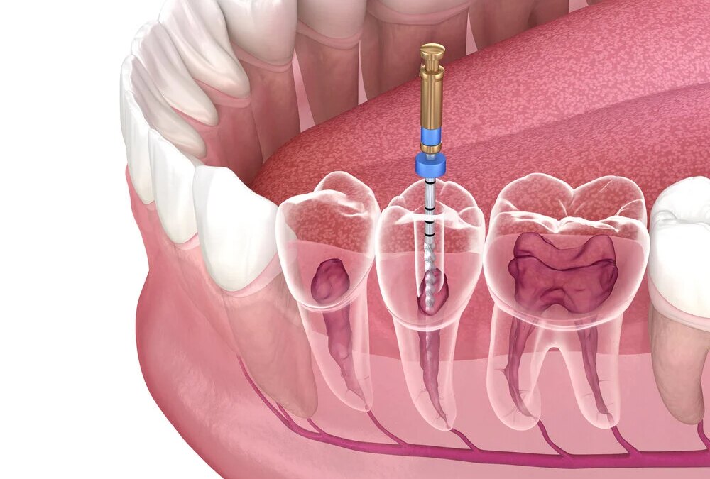 Is Root Canal Treatment Really Effective?