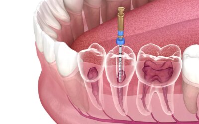 Is Root Canal Treatment Really Effective?