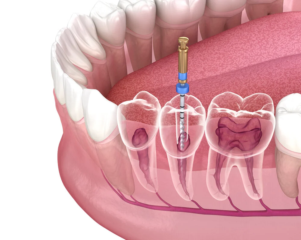 Is Root Canal Treatment Really Effective?