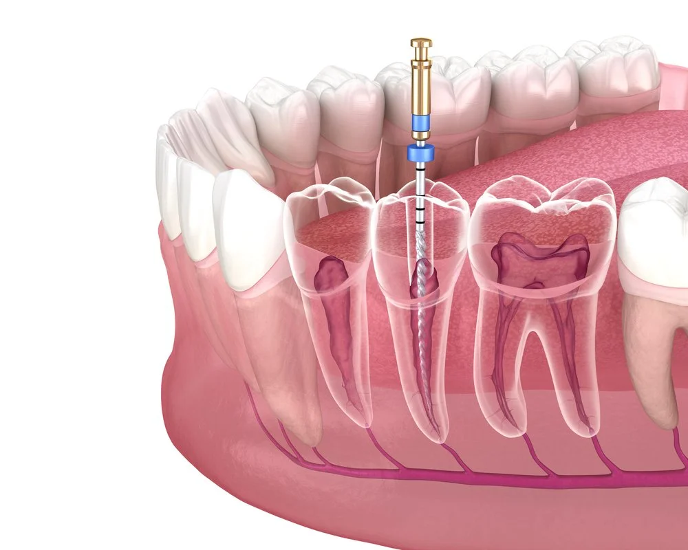 How to Know If You Need a Root Canal?