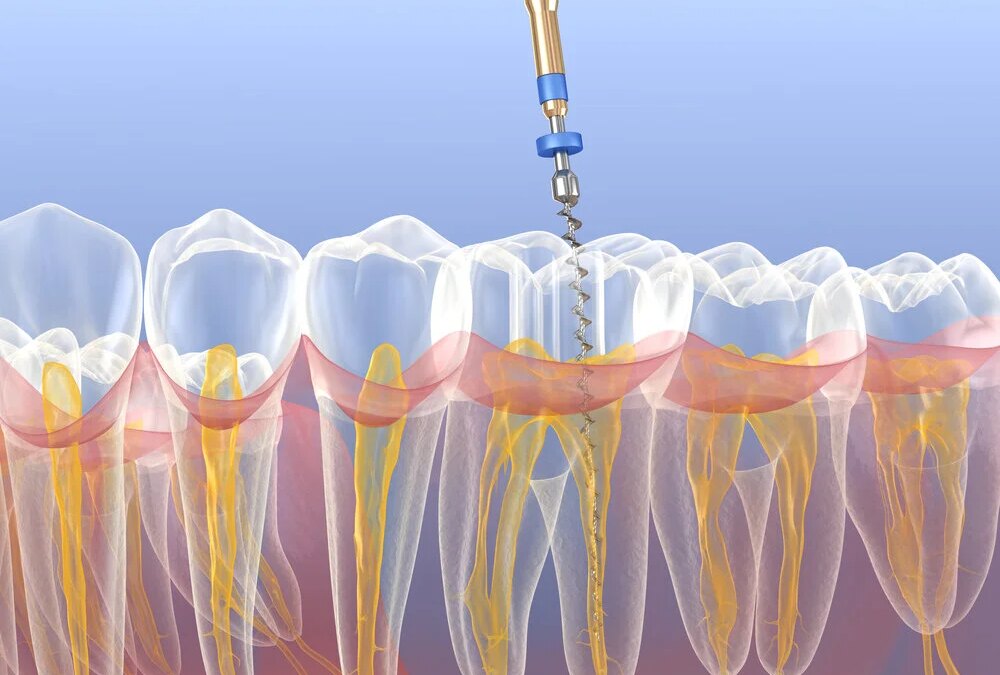 A Detailed Guide on Root Canal Process