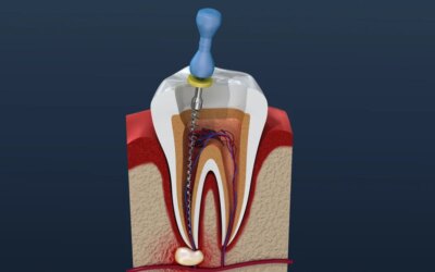 Root Canal Treatment: The Details You Must Know