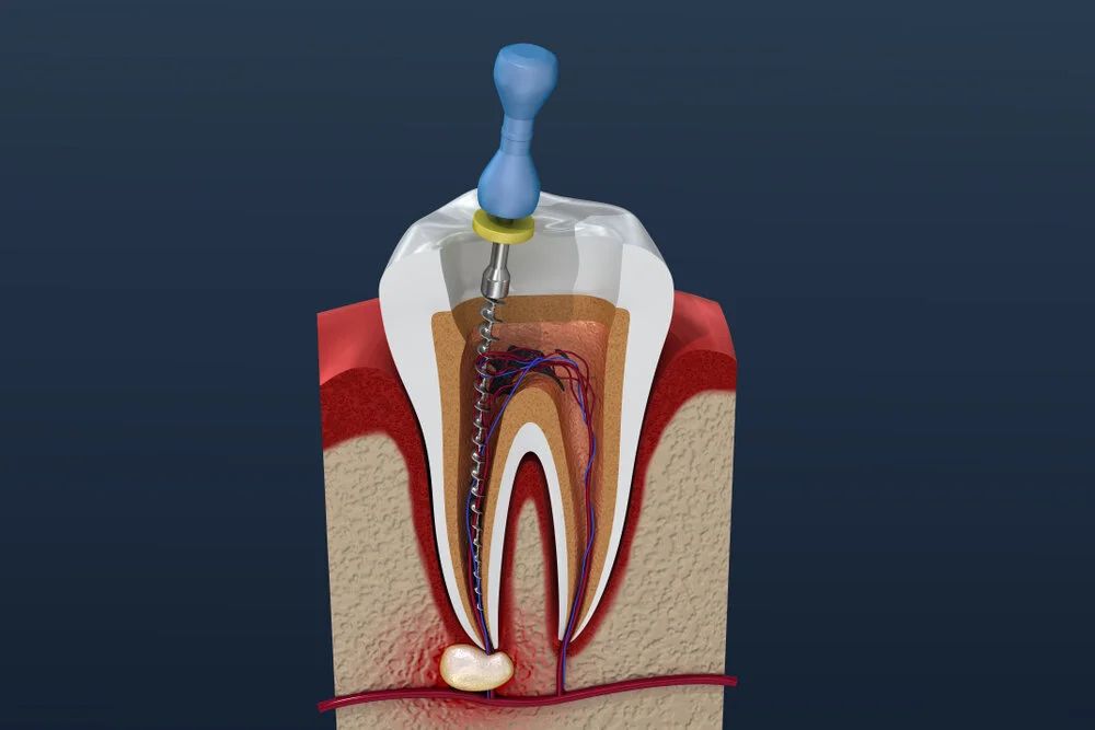 Root Canal Treatment: The Details You Must Know